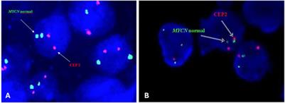 Application of the FISH method and high-density SNP arrays to assess genetic changes in neuroblastoma—research by one institute